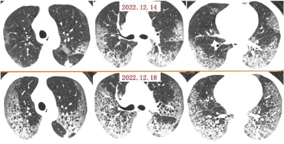 新冠后的“白肺”焦虑，，，，，怎样早诊断早治疗？？？？？-新闻动态|健培科技