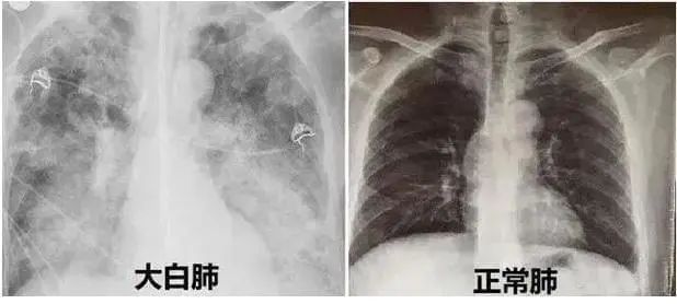 新冠后的“白肺”焦虑，，，，，怎样早诊断早治疗？？？？？-新闻动态|健培科技